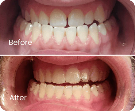 Underbite